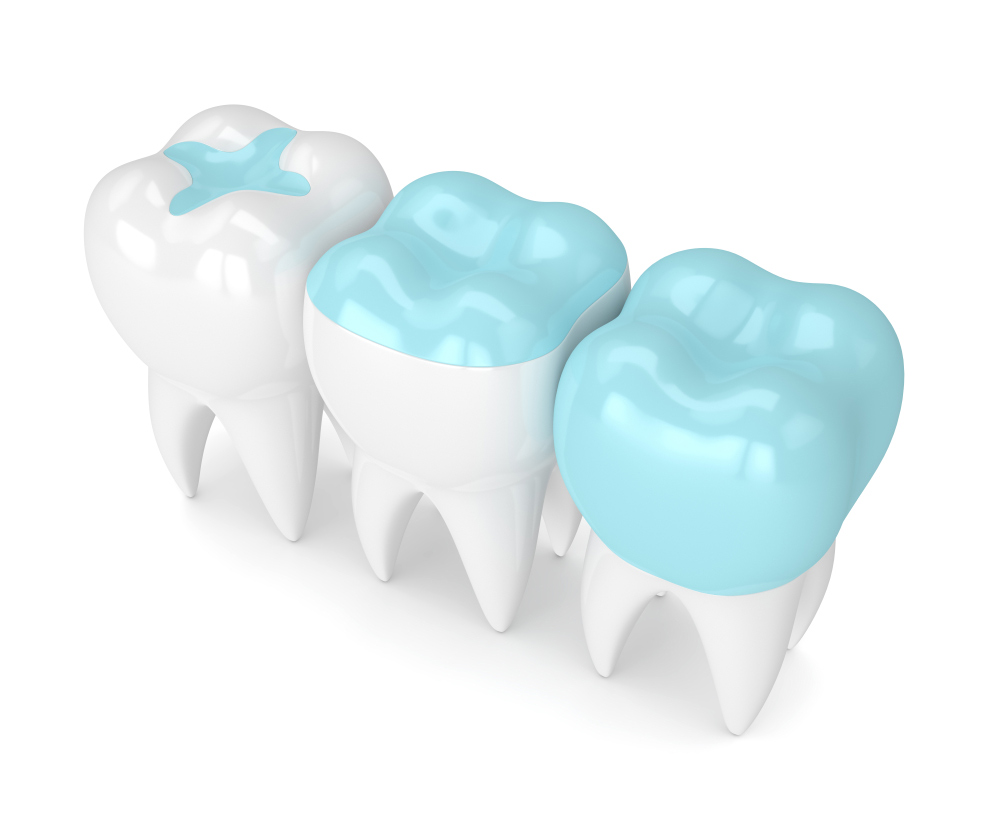 What Are Dental Implants?