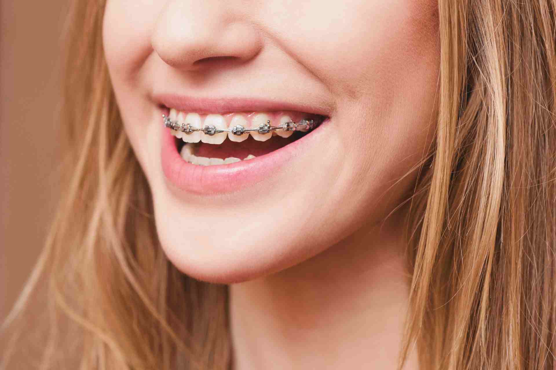 What’s the Best Color for Braces?