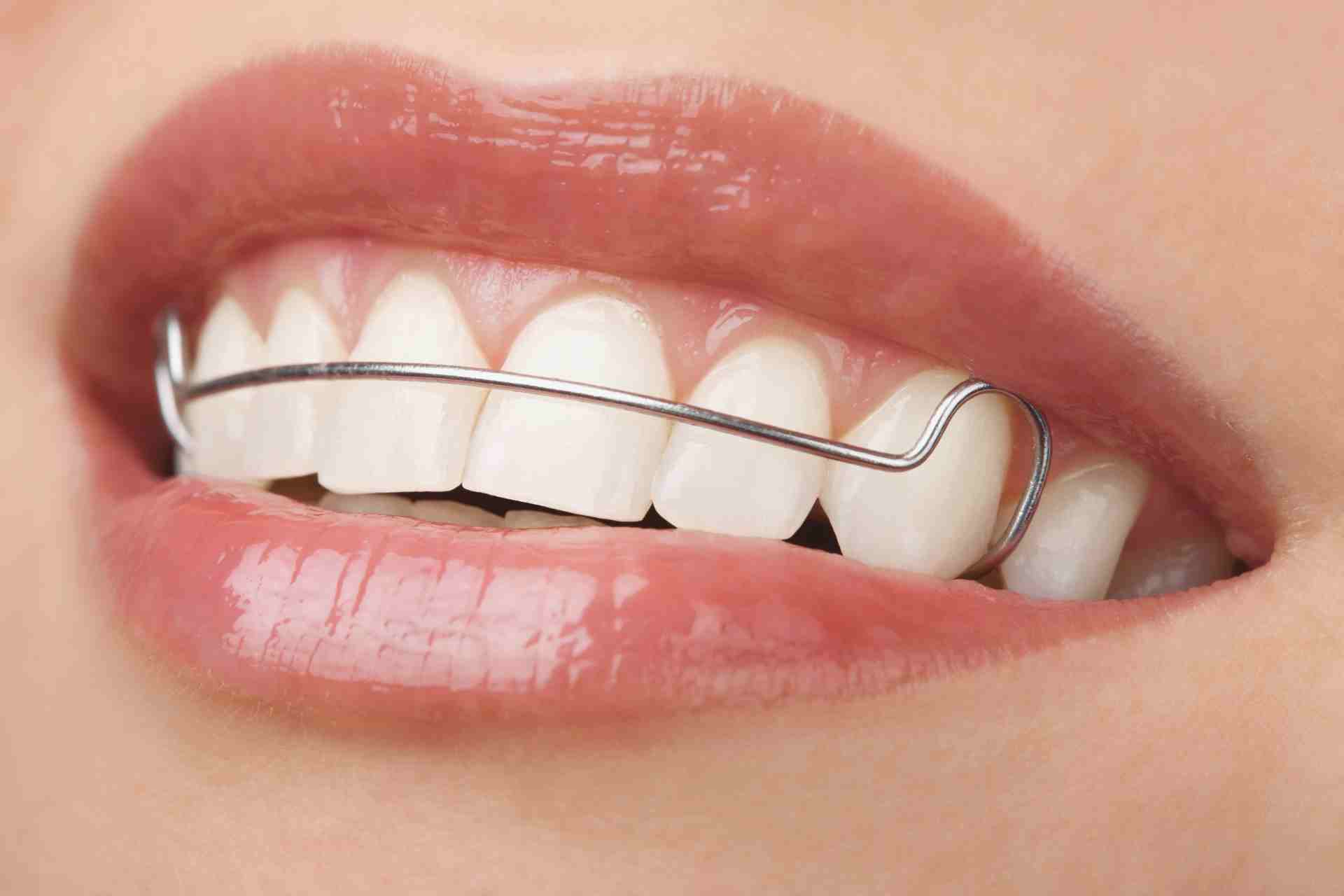 How to Floss with a Permanent Retainer?
