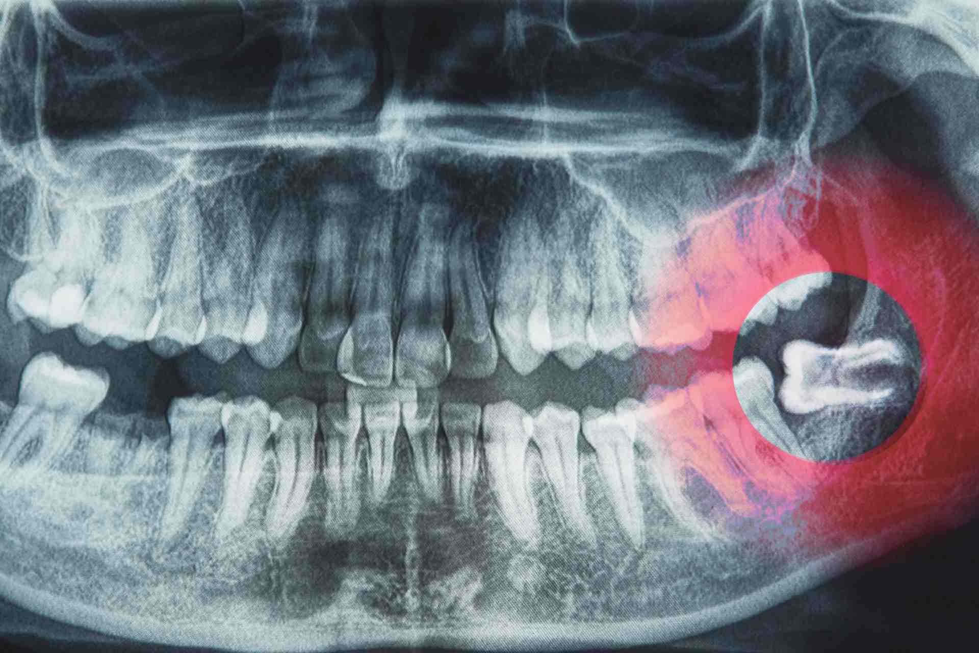 What Age Do Wisdom Teeth Come In?