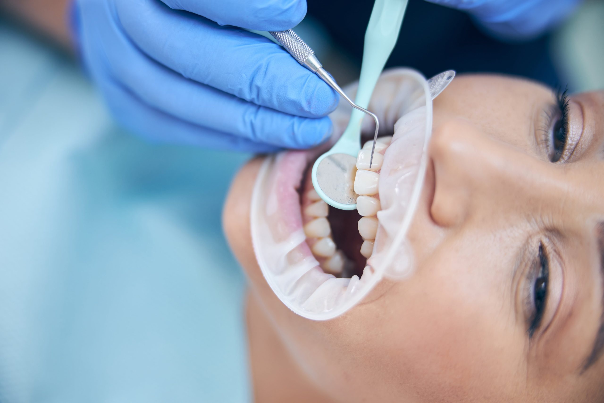 Can a Filling Fall Out? What You Need to Know