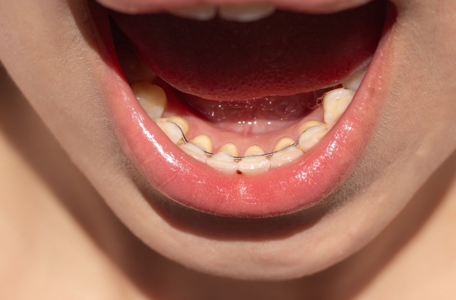 How to Floss with a Permanent Retainer?