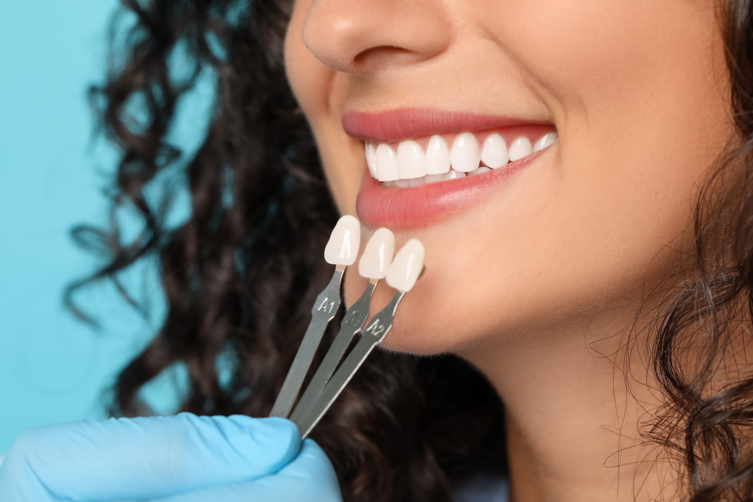 How Much Do Veneers Cost?